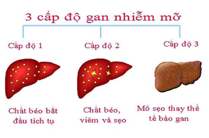 bệnh gan nhiễm mỡ, gan nhiễm mỡ, dấu hiệu gan nhiễm mỡ