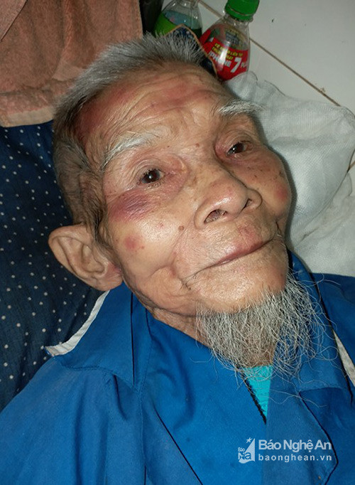 Cụ già cao tuổi bị ong đốt đang điều trị tại Bệnh viện