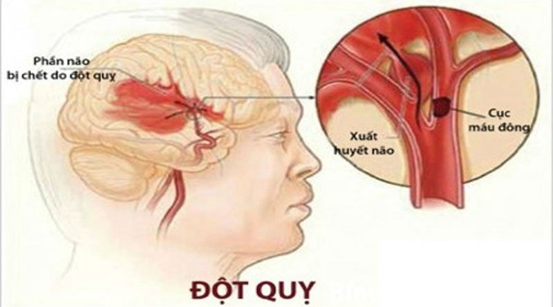 đột quỵ,tai biến mạch máu não