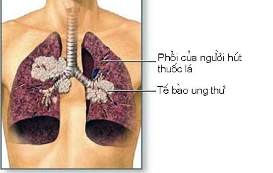 Với những người không hút thuốc, ung thư phổi không hề phổ biến.