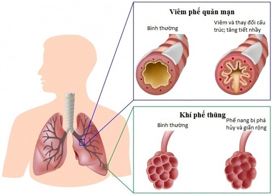Hút thuốc lá là nguyên nhân chính gây nên bệnh phổi tắc nghẹn mãn tính.
