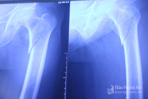 Hình ảnh phim X-Quang của bệnh nhân trước và sau mổ. Ảnh: Đinh Nguyệt