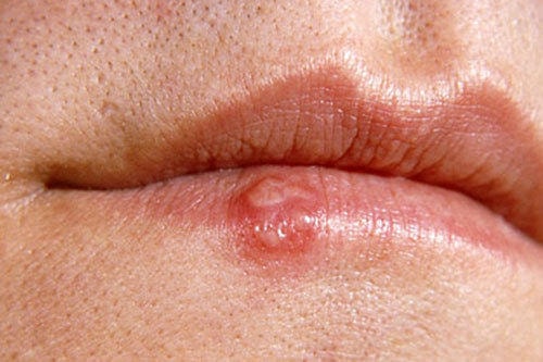 6. Mụn rộp hoặc herpes sinh dục: Lở loét lạnh (herpes miệng) và herpes sinh dục có thể là một dấu hiệu của cả giai đoạn ARS và nhiễm HIV giai đoạn cuối. Mặt khác, có herpes cũng làm tăng nguy cơ lây nhiễm HIV. Điều này là do herpes sinh dục có thể gây viêm loét làm HIV dễ dàng đi vào cơ thể khi quan hệ tình dục. Ảnh minh họa