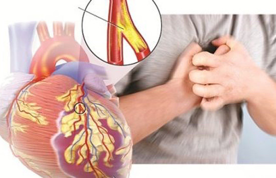 Người hút thuốc lâu năm sẽ phải chịu cơn đau thắt ngực và đau tim ở mức độ cao hơn người không hút thuốc. 