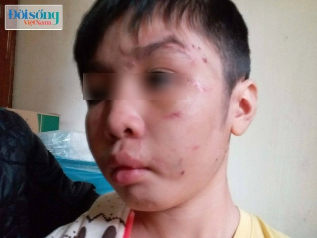 Bé trai 10 tuổi bị bố ruột và mẹ kế bạo hành ở Hà Nội với chi chít những vết sẹo trên mặt