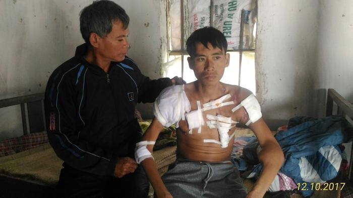 Suốt gần 11 năm chạy thận khiến cơ thể Minh gầy gò, ốm yếu. Ảnh Hồ Văn.
