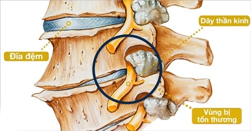 Cột sống bị thoái hóa xuất hiện chèn ép dây thần kinh.