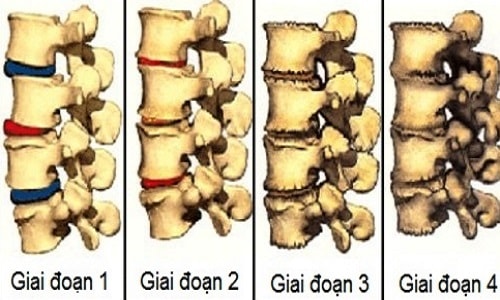 Hình ảnh mô phỏng các giai đoạn thoái hóa cột sống.