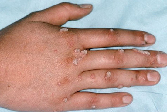  Người hút thuốc dễ bị nhiễm trùng do virus HPV gây ra, tăng nguy cơ phát triển mụn cóc trên môi, mặt, tay chân, bộ phận sinh dục...