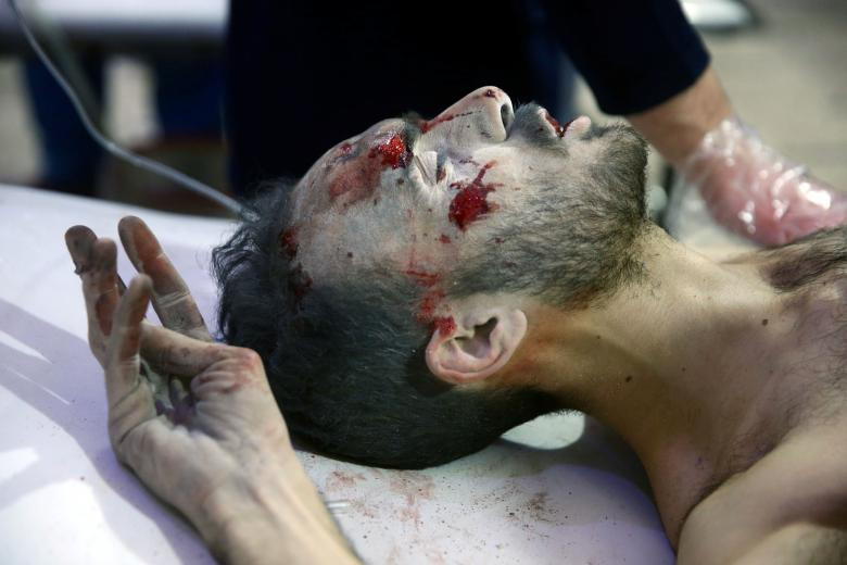 Một người đàn ông bị thương được nhìn thấy trong một bệnh viện ở thị trấn Douma, Đông Ghouta, Damascus, 23 tháng Hai