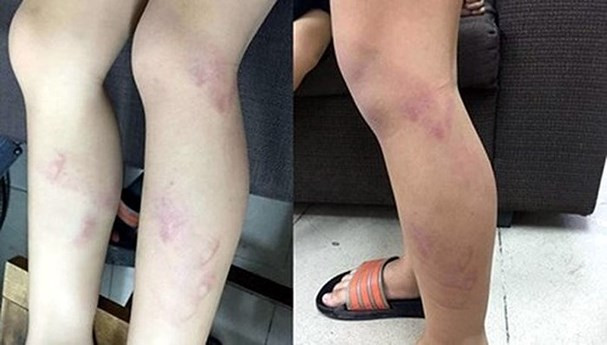 Học sinh bị cô giáo đánh tím chân tại Trường Tiểu học Nguyễn Tri Phương, Hà Nội. Ảnh: Internet