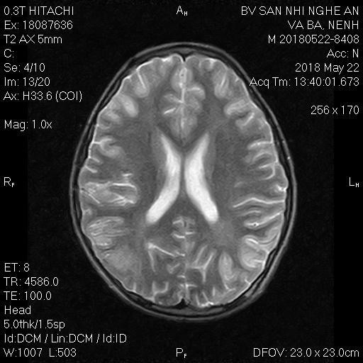 Cơ quan thần kinh não của bệnh nhân V.B.Nênh bị tổn thương nghiêm trọng qua phim chụp cộng hưởng từ (MRI). Ảnh: Thu Hiền