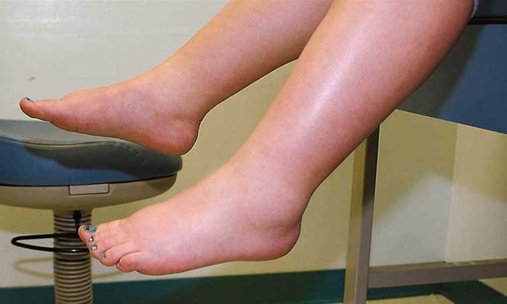Sưng hoặc phù nề trong thời gian dài: Các trường hợp sưng nhẹ ở bàn chân có thể do ngồi hoặc đứng ở một vị trí quá lâu, lượng muối cao, suy dinh dưỡng, béo phì, lão hóa, lối sống ít vận động, hội chứng tiền kinh nguyệt (PMS) và mang thai. Tuy nhiên, nếu bạn bị phù nề hoặc sưng ở bàn chân trong một thời gian, nó có thể là do lưu thông máu kém. Trong trường hợp nặng, lưu thông kém cũng có thể gây loét chân.