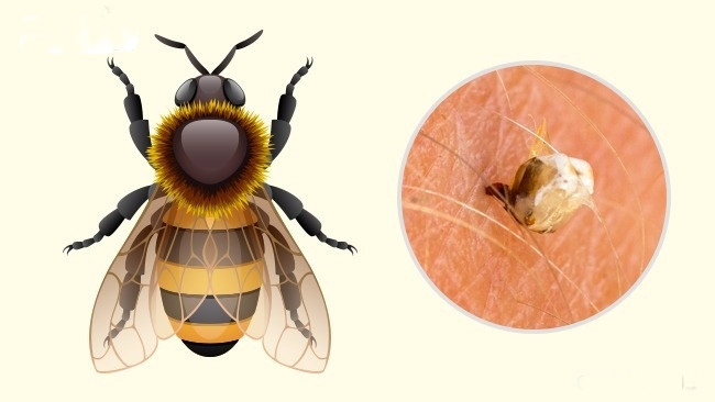 Khi bị ong vàng đốt, da thường bị đỏ và sưng; người cảm thấy nóng rát, đau dữ dôịvà ngứa xuất hiện sau đó. Nếu bạn không bị dị ứng thì sẽ không có gì quá nghiêm trọng. Tuy nhiên, nếu bị dị ứng với chất độc của ong vàng, người bị đốt có thể có vấn đề về hô hấp; thậm chí dẫn đến tử vong.