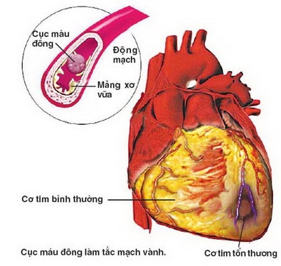 Thuốc lá thuộc nhóm yếu tố nguy cơ hàng đầu gây các bệnh mãn tính về tim mạch. Người hút thuốc lá đang tự làm hại hệ thống mạch máu, tim của mình theo thời gian mà không hề hay biết. Rất nhiều nghiên cứu đã chỉ ra rằng: Thuốc lá tổn thương thành động mạch, tạo nên một lớp xơ vữa. Theo thời gian, lớp tích tụ này khiến động mạch bị thu hẹp, cản trở luồng máu lưu thông. Xơ vữa động mạch chính là một trong những yếu tố dẫn đến cơn đau tức ngực, nhồi máu cơ tim, đột quỵ…