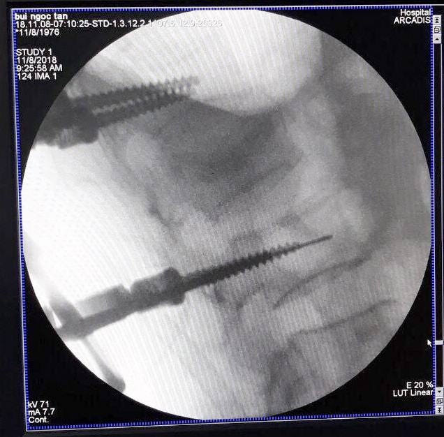 Hình ảnh bắt vít dưới sự hướng dẫn của máy C- ARM.