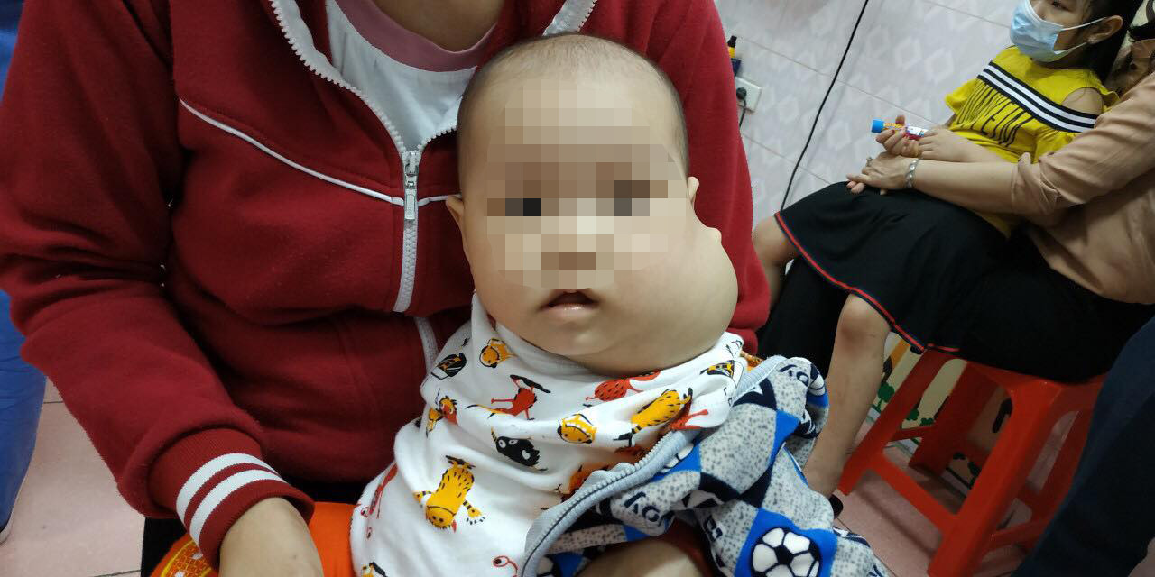 Em bé 8 tháng tuổi bị khối u dày kích thước lớn, dính ở cổ. Ảnh: Hoài Giang