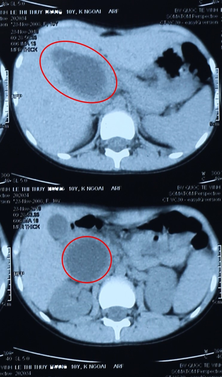 Hình ảnh chụp cộng hưởng từ (MRI) ổ bụng. Ảnh: Kim Chung
