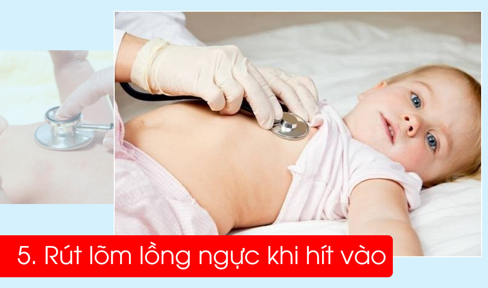 Dấu hiệu rút lõm lồng ngực khi trẻ hít vào là khi bé hít vào, phần dưới lồng ngực không phình ra như thường lệ mà lõm vào, nguyên nhân là do cơ hoành phân cách ổ bụng và lồng ngực cũng tham gia vào quá trình thở.