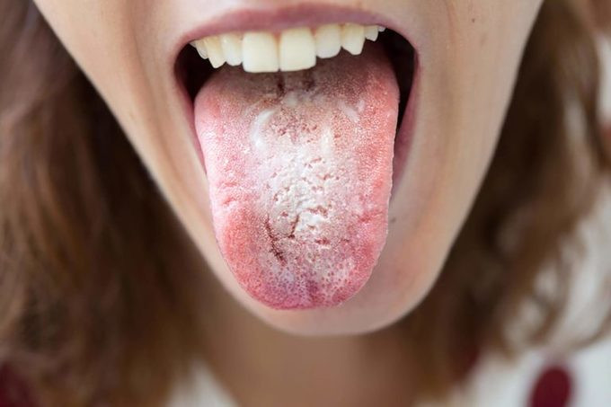 10 cách khắc phục bệnh tưa miệng
