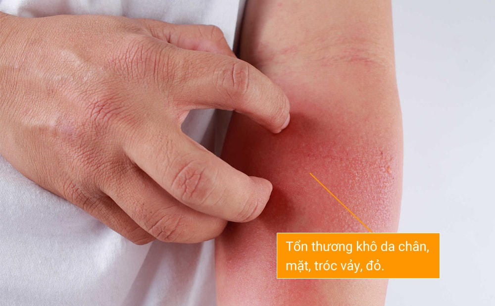 Biểu hiện: Tổn thương khô da chân, mặt, tróc vảy, đỏ.  Cách phòng: Tránh tiếp xúc với hóa chất tẩy rửa. Uống nhiều nước. Không mặc đồ quá chật, tránh mặc chất liệu vải len, sợi tổng hợp vì dễ gây kích ứng. Không tự ý sử dụng thuốc, nhất là thuốc bôi có chứa corticosteroids.