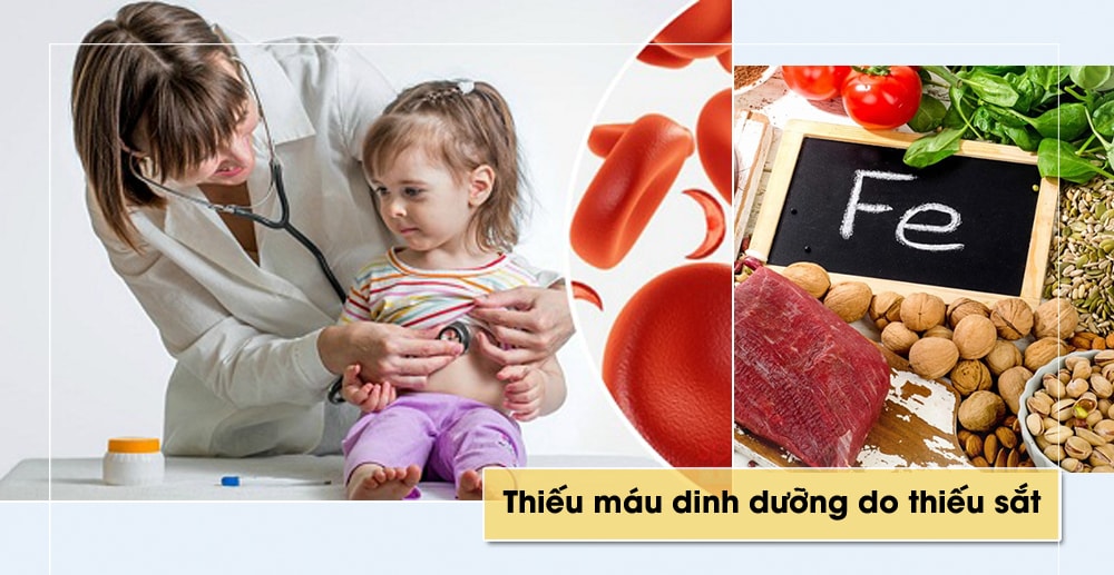 Thiếu sắt gây thiếu máu - đây là tình trạng thường gặp ở trẻ em. Khi thiếu máu, trẻ da xanh, kém hoạt bát; hay bị viêm nhiễm đường hô hấp và các bệnh nhiễm khuẩn… Sắt được cung cấp cho cơ thể từ thức ăn động vật (thịt bò, lòng đỏ trứng gà, tim, gan, bầu dục, cá...) và thức ăn thực vật (đậu, rau lá xanh, mộc nhĩ, nấm hương...). Để tăng hấp thu sắt, nên ăn hoa quả cung cấp nhiều vitamin C.