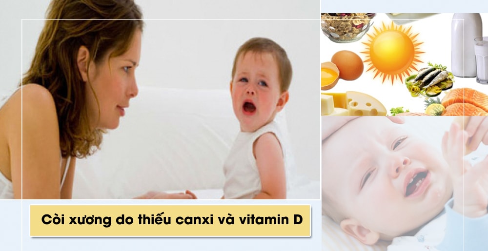 Bệnh còi xương ở trẻ em chủ yếu là do thiếu vitamin D; khi thiếu vitamin D sẽ làm giảm hấp thu canxi ở ruột, cơ thể sẽ huy động canxi ở xương vào máu gây rối loạn quá trình khoáng hóa xương. Trẻ bị còi xương thường ngủ không yên giấc, rụng tóc, răng mọc chậm. Các thực phẩm có nhiều canxi: tôm, cua, cá, sữa, rau dền, rau mồng tơi...; Còn vitamin D có nhiều trong dầu gan cá, cá biển, gan, trứng gà bột ngũ cốc, sữa...