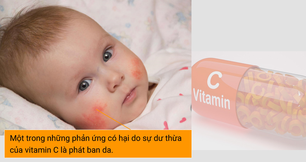 4. Phát ban da. Một trong những phản ứng có hại do sự dư thừa của vitamin C là phát ban da. Điều này xuất hiện chủ yếu ở trẻ nhỏ; nó thể hiện ra bên ngoài giống như một phản ứng dị ứng.