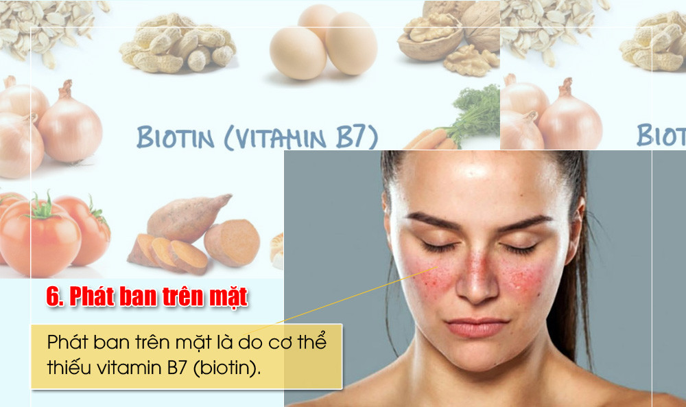 Phát ban trên mặt là do cơ thể thiếu vitamin B7 (biotin). Ngoại trừ các viên bổ sung dinh dưỡng, bạn có thể tăng lượng biotin bằng cách cải thiện chế độ ăn uống. Nên ăn nấm, khoai tây, phô mai, trứng luộc, rau bina và súp lơ.