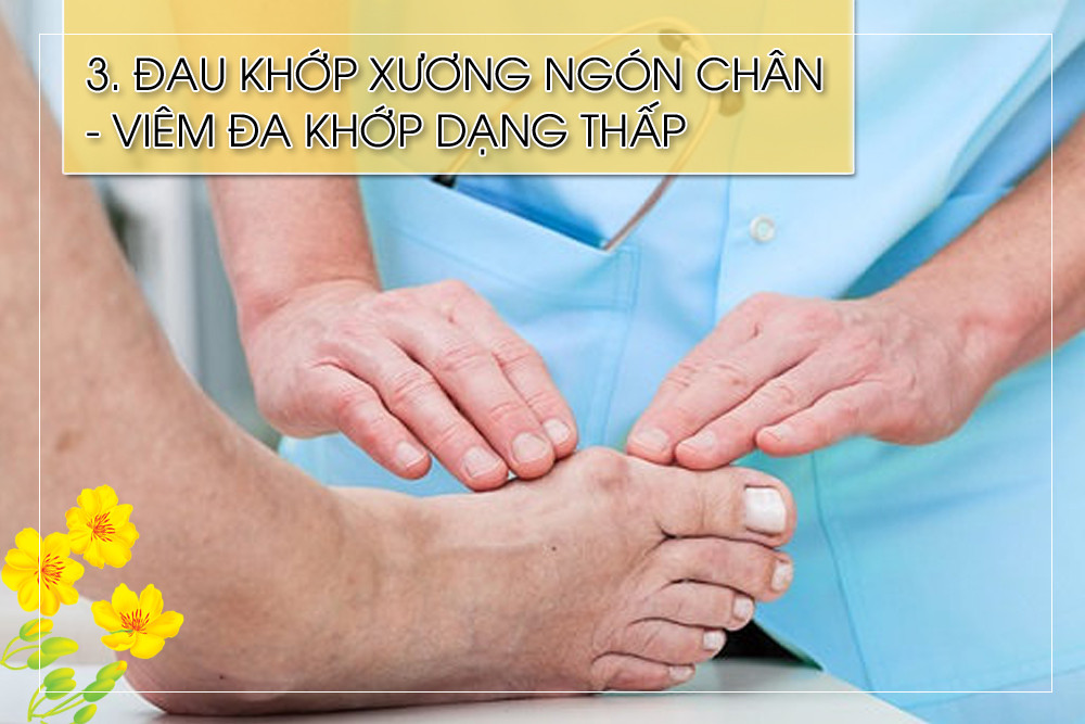 Viêm đa khớp dạng thấp thường xảy ra nơi các khớp xương nhỏ như ở ngón chân và các đầu xương bàn tay. Viêm đa khớp dạng thấp phát triển đột ngột hơn viêm khớp thoái hóa và cơn đau lúc có lúc không. Phụ nữ có nguy cơ mắc bệnh này cao gấp bốn lần so với đàn ông.
