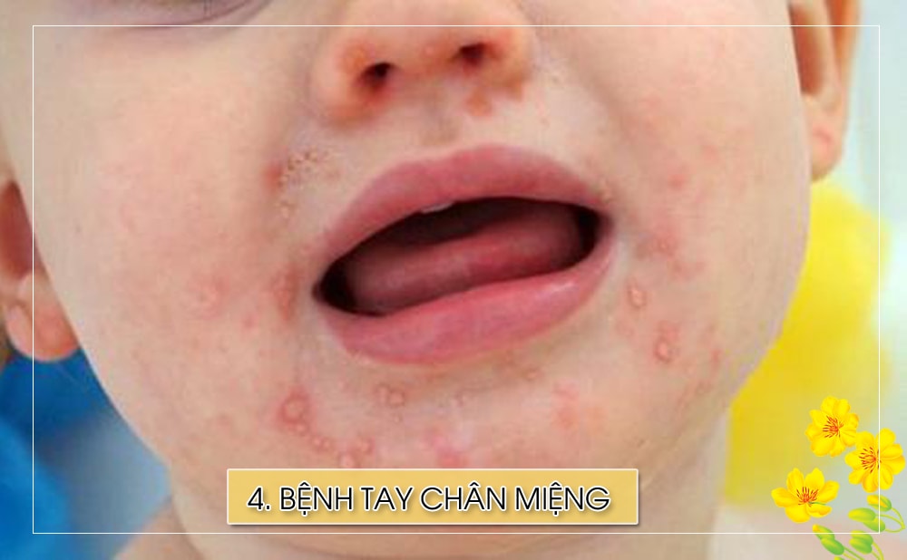 Cha mẹ cần lưu ý về các dấu hiệu bệnh tay chân miệng ở trẻ sau mùa lễ tết, bởi bệnh này rất dễ lây nhiễm. Biểu hiện bệnh là đau họng, sốt, nổi mẩn ở miệng, tay, chân hoặc mông, loét họng, lưỡi và miệng, biếng ăn... Nguyên nhân do enterovirus, lây tiếp xúc trực tiếp với nước bọt, nước mũi, dịch tiết của người nhiễm bệnh.