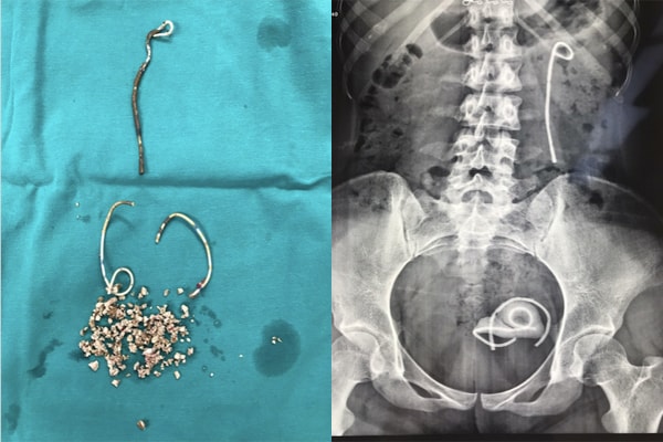 Đoạn stent kèm sỏi được lấy ra khỏi bụng bệnh nhân. Ảnh: An Ngọc.