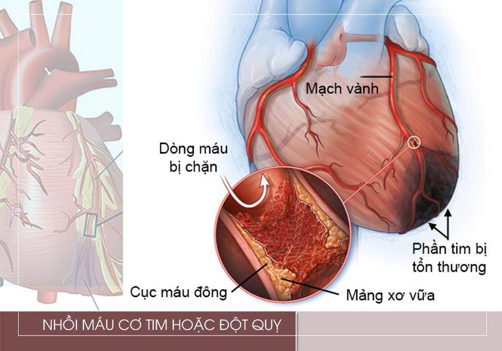 Khi hiệu quả bơm máu của tim giảm, máu có thể bị ứ đọng tại các buồng tim và hình thành nên cục máu đông. Cục máu đông có thể di chuyển tới các mạch máu, làm tắc mạch, dẫn đến các biến chứng nguy hiểm như nhồi máu cơ tim, đột quỵ.