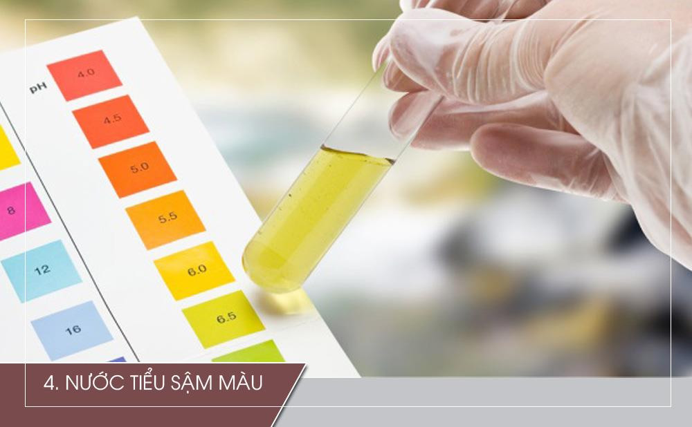 Khi nước tiểu của bạn bắt đầu chuyển sang sẫm màu (màu nâu hoặc rỉ sét), đây có thể là một trong những triệu chứng ung thư tuyến tụy nên chú ý. Nguyên nhân là do bilirubin - một chất được tạo ra bởi gan, một phần tạo thành mật - đã tích tụ trong máu và làm cho nước tiểu sậm màu.