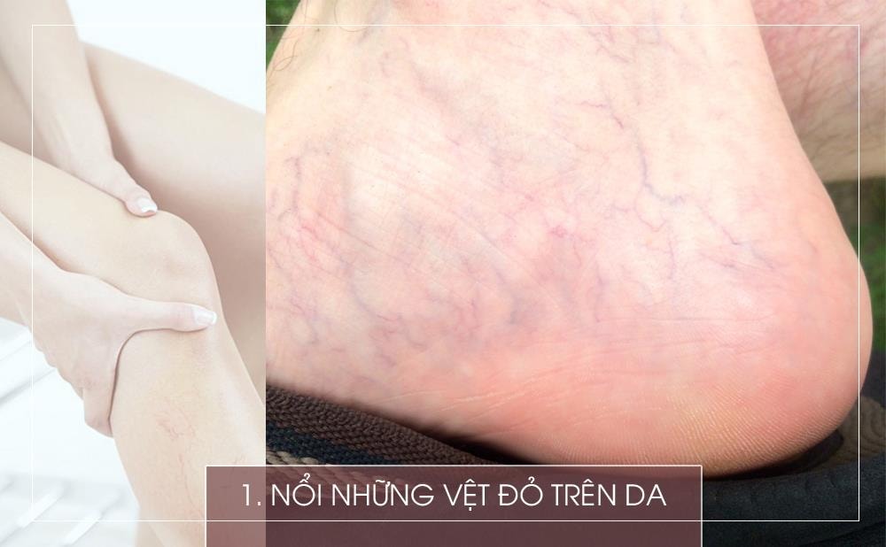 Thực tế, một vết bầm tím là một dạng cục máu đông và bạn không cần phải quá lo lắng. Nhưng cần lưu ý khi thấy sự thay đổi màu sắc ở da mà cụ thể là sắc đỏ. Huyết khối tĩnh mạch sâu gây ra các vệt đỏ dọc theo tĩnh mạch ở chi bị tổn thương, và khiến cánh tay hoặc chân ấm hơn khi chạm vào.