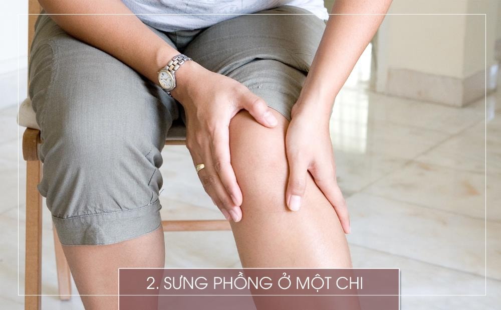 Một bên chân hay cánh tay sưng húp là  dấu hiệu phổ biến của huyết khối tĩnh mạch sâu. Cục máu đông có thể làm nghẽn dòng lưu thông máu ở chân và máu đổ về phía sau cục máu đông, gây tình trạng sưng tấy… Hãy cẩn thận nếu hiện tượng này xảy ra cùng với một bên chân bị đau.