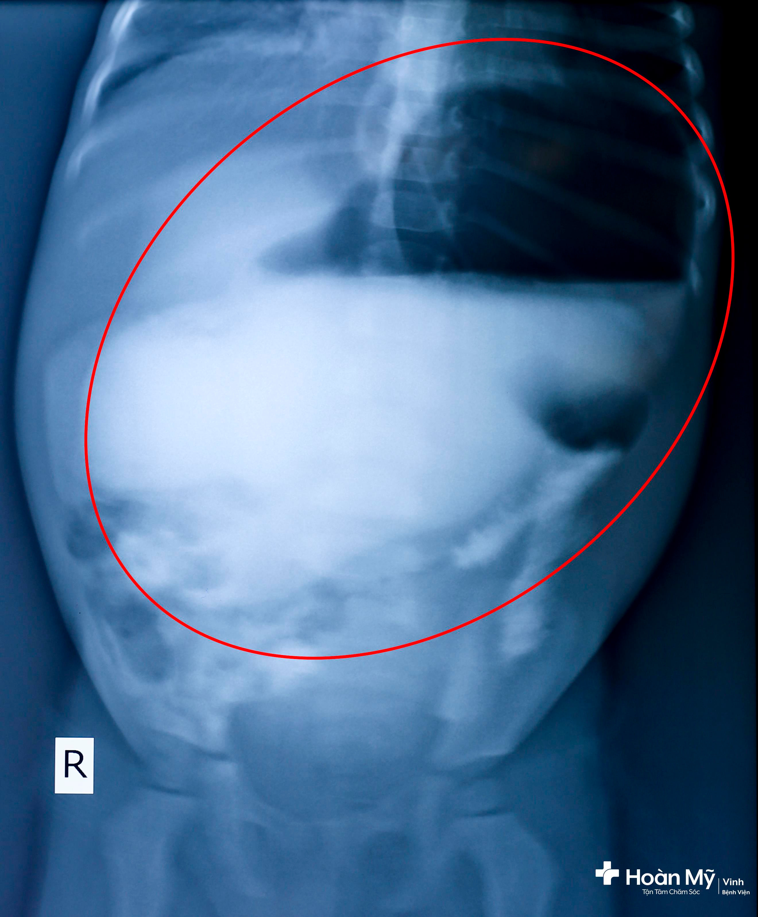 Hình ảnh chụp X- quang dạ dày giãn lớn.