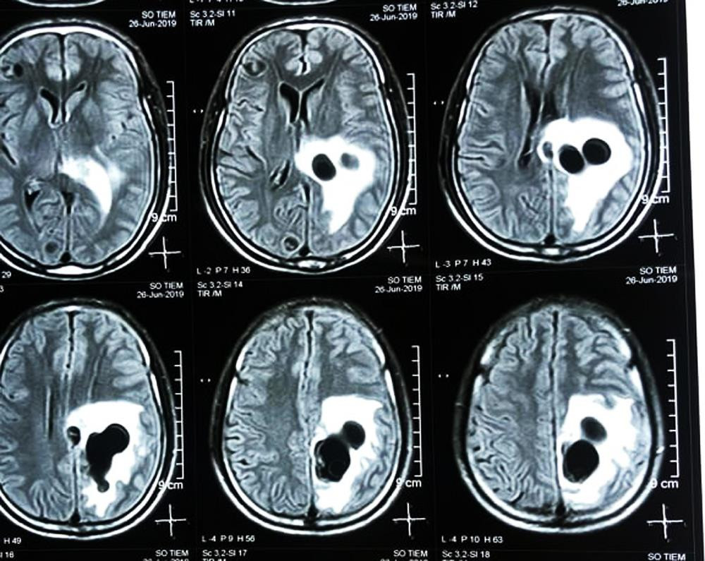 Kết quả chụp CT não cho thấy có 5 ổ sán nằm rải rác trong não. Ảnh: Hoàng Yến