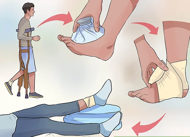 4bước sơ cứu người bị bong gân, trật khớp.