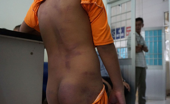 Vết bầm tím trên cơ thể của 1 trong 4 học sinh nghi bị bạo hành. Ảnh: Nguyễn Hùng