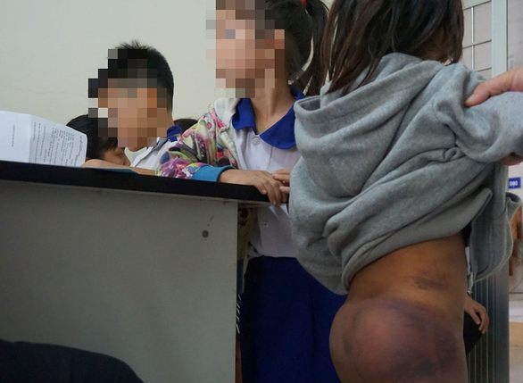 Vết thương trên mông của một học sinh. Ảnh: Nguyễn Hùng