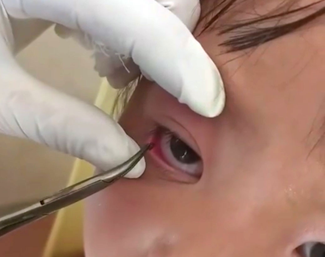 Phẫu thuật gắp vắt từ mắt bé gái người Mông.