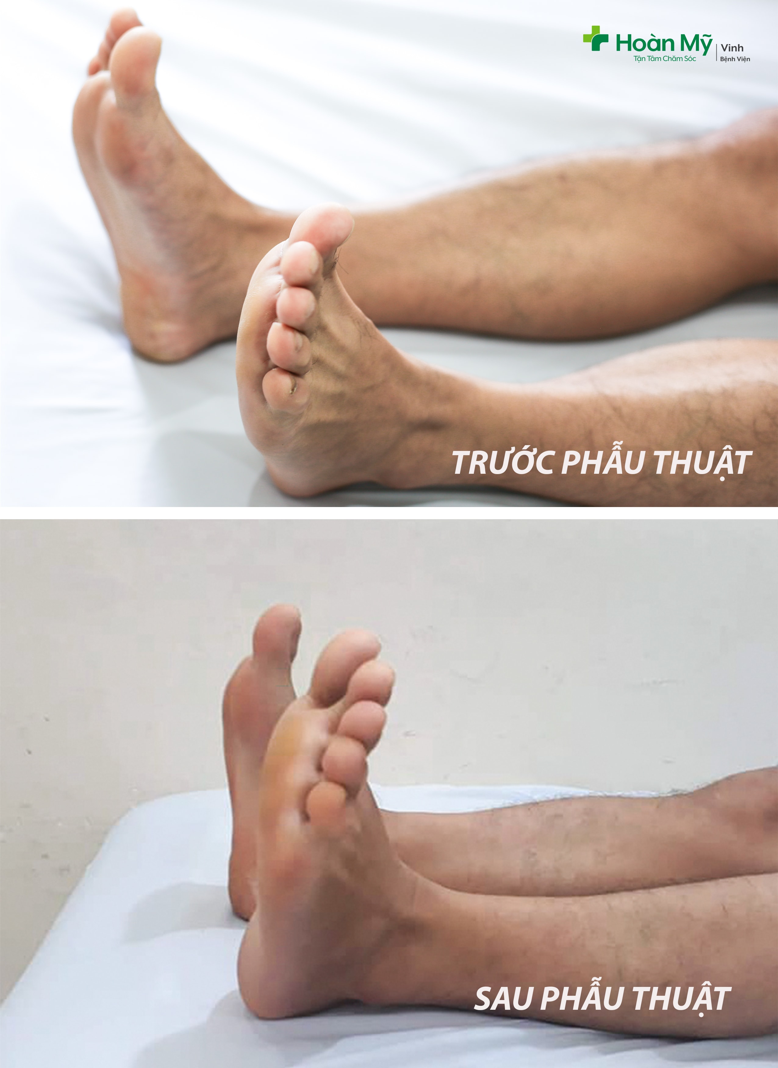 Hinh ảnh đôi chân người bệnh trước và sau phẫu thuật.