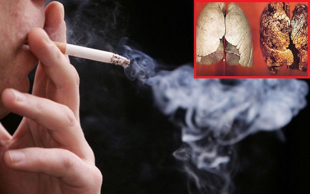 90% người mắc ung thư phổi là người hút thuốc lá. Hút thuốc là nguyên nhân của 75% các ca bệnh phổi tắc nghẽn mạn tính. Ảnh: Internet