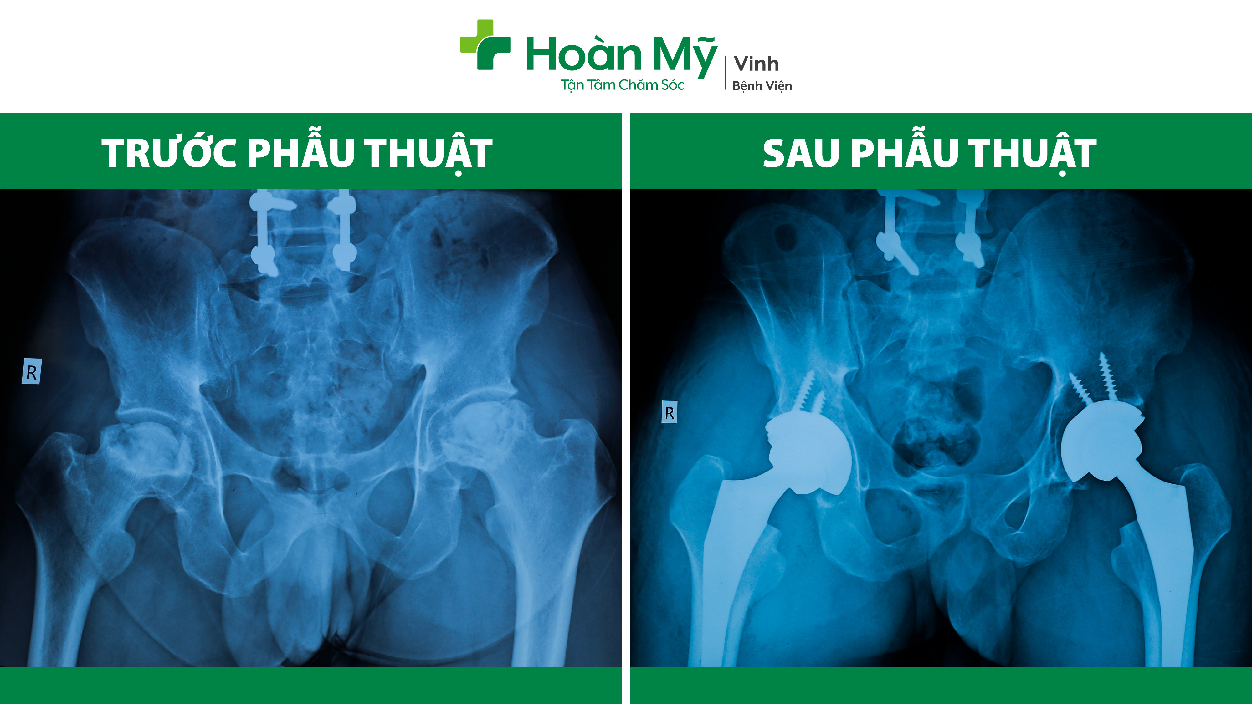 Hình ảnh phim X - Quang trước và sau phẫu thuật.