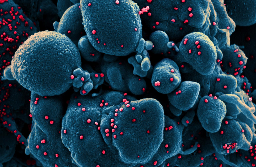 Ảnh quét màu một tế bào apoptotic (màu xanh) bị nhiễm các hạt virus Sars-CoV-2 (màu đỏ) gây ra Covid-19 (Nguồn: Reuters)