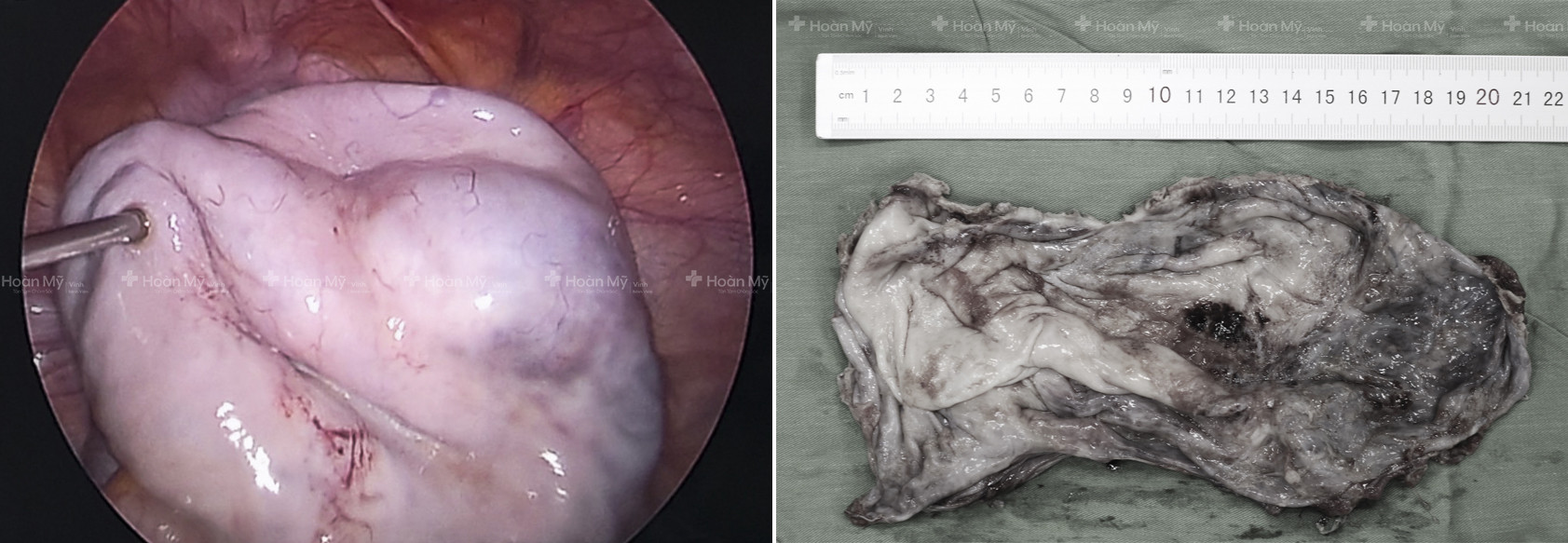 Hình ảnh khối u qua màn hình nội soi (ảnh trái) và hình ảnh khối u sau khi được phẫu thuật (ảnh phải). Ảnh: Kim Chung