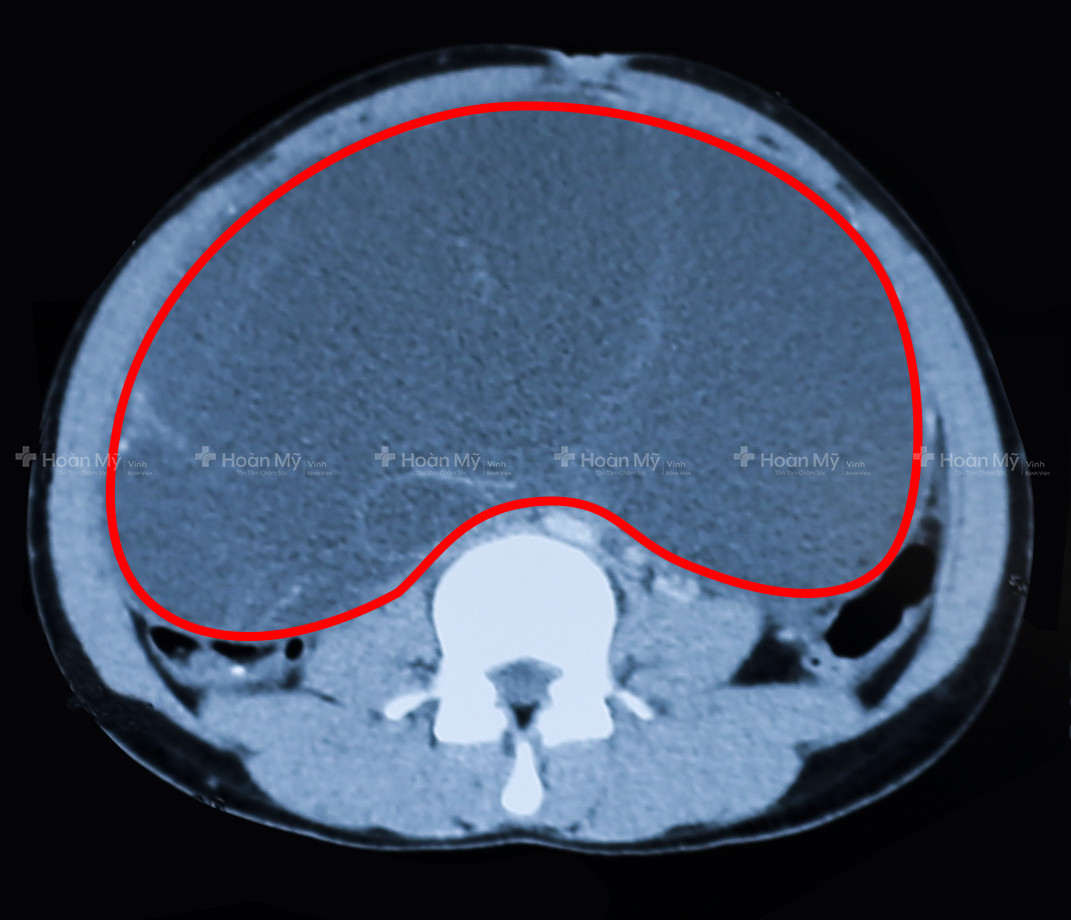 Hình ảnh chụp cắt lớp vi tính khối u choán gần hết ổ bụng.