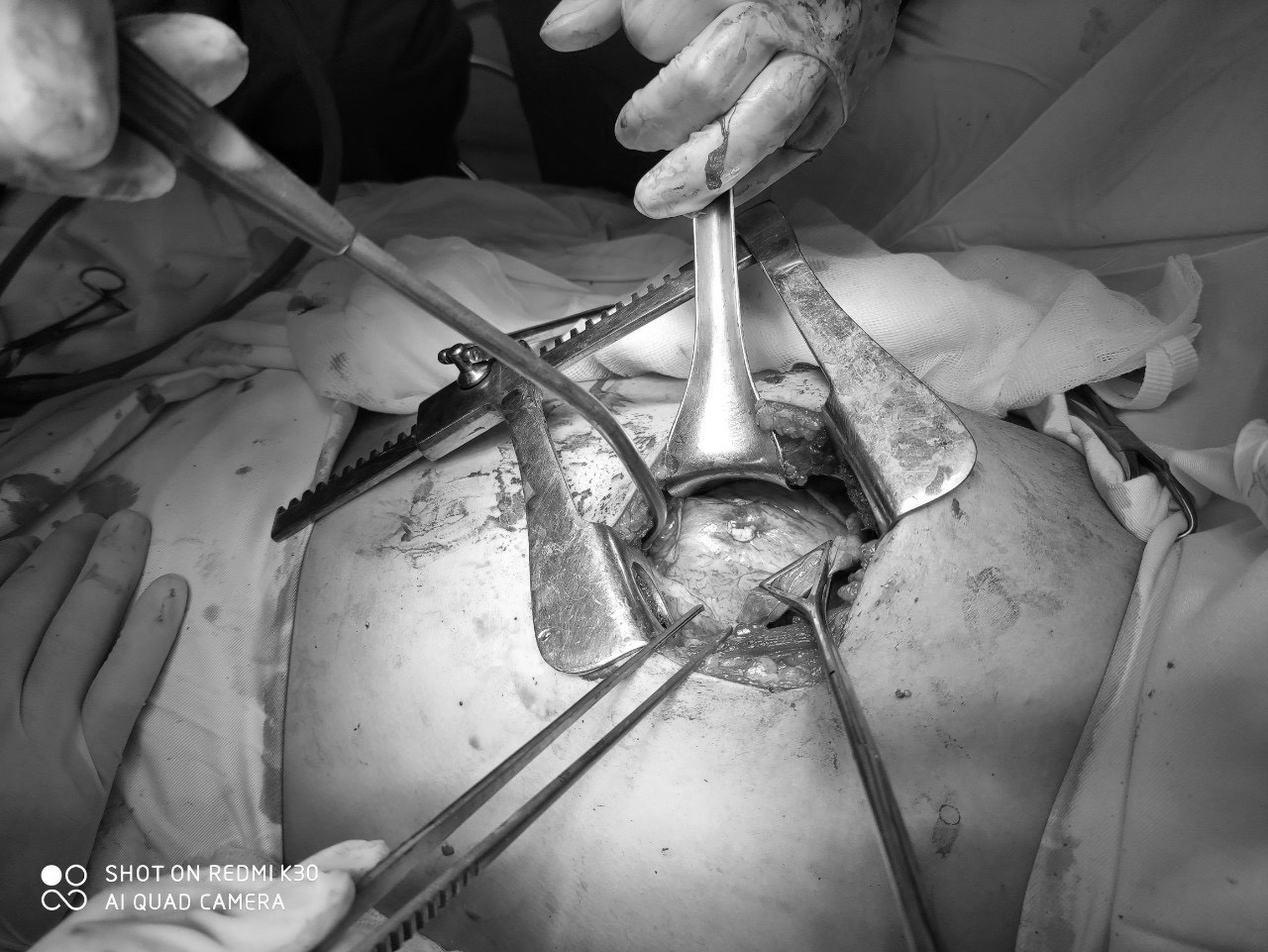 Các bác sĩ tiến hành mở ngực bệnh nhân T để khâu các vết thương tim và lấy đầu đạn. Ảnh: Từ Thành