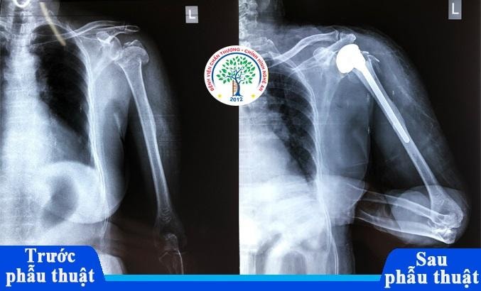 Phim chụp xquang trước và sau phẫu thuật của bệnh nhân L.T.M.